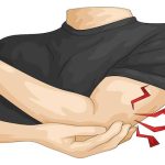 Dirsekte Ulnar Sinir Sıkışmasına Güncel Bakış: 2025 Verileri Kubital Tünel Sendromu Tedavisinde Ne Diyor?