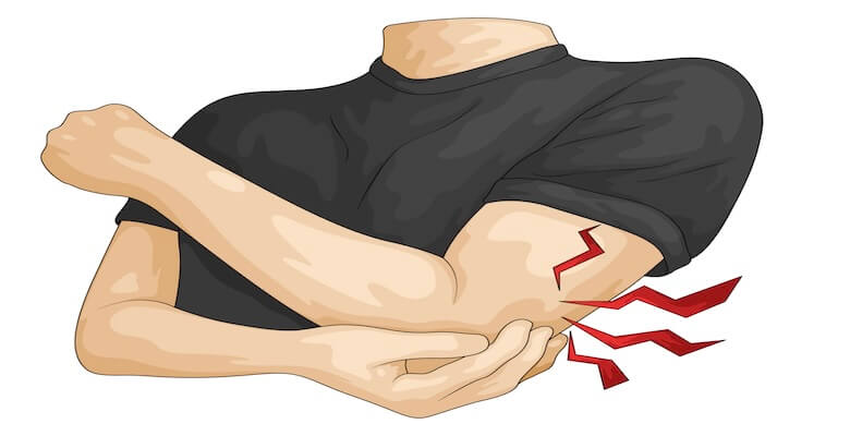 Dirsekte Ulnar Sinir Sıkışmasına Güncel Bakış: 2025 Verileri Kubital Tünel Sendromu Tedavisinde Ne Diyor?